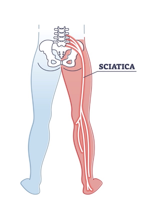 diagram of the sciatic nerve