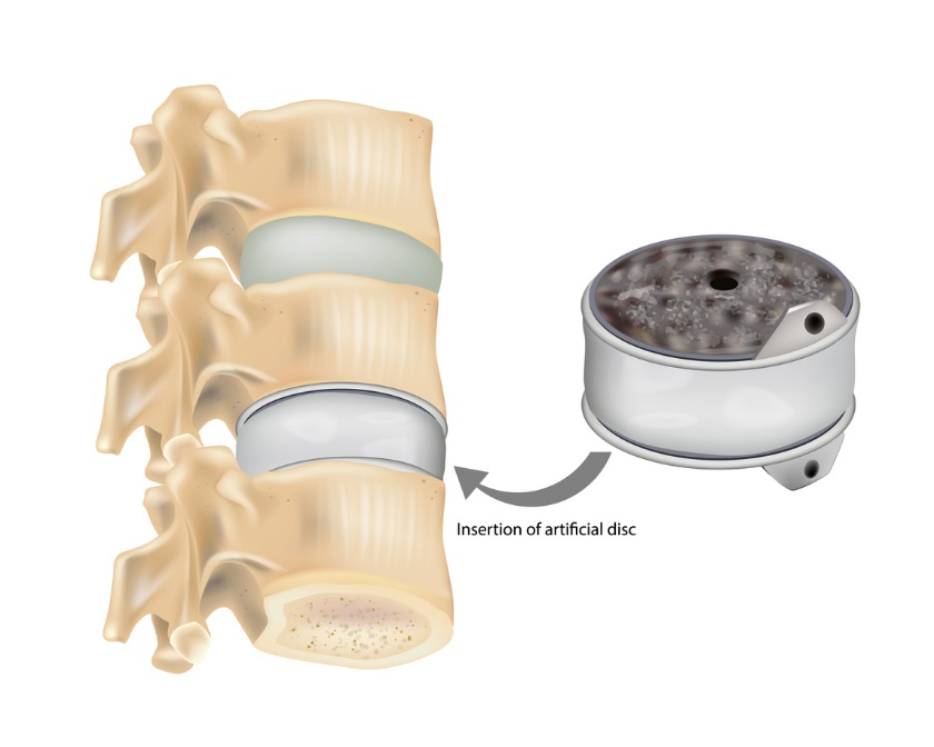 Nerve decompression without surgery., Illustration of artificial disc insertion into the spine for disc replacement surgery.