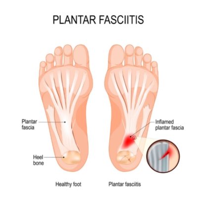 Diagram illustrating plantar fasciitis